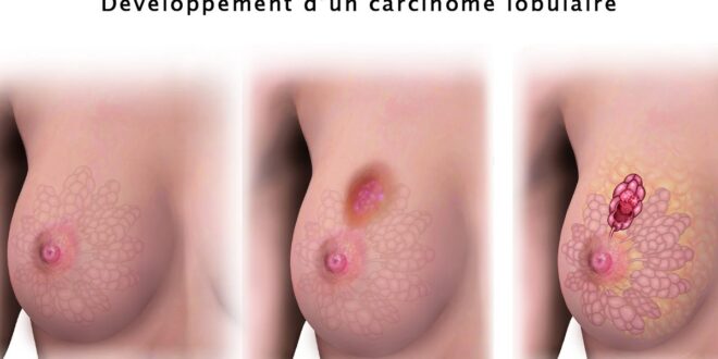 Le carcinome lobulaire in situ et infiltrant 1 1200x700 1